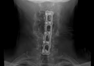Sandy Eulitt uses Life Backup Plan app for Cervical Spine Surgery Recovery