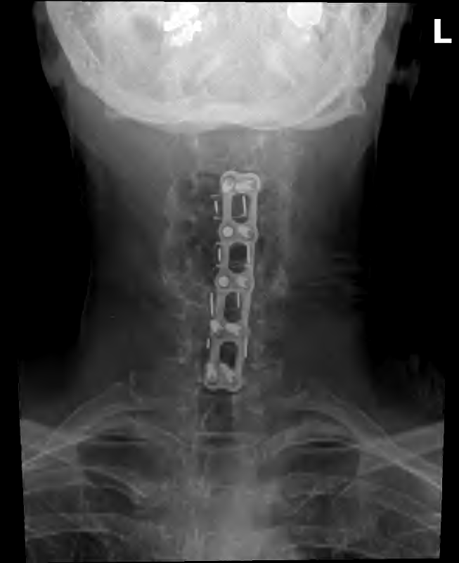 X-ray image of cervical spine showing ACDF (anterior cervical decompression and fusion) from C3 to C7 with metal plate and ten screws from November 2021 cervical spine surgery.